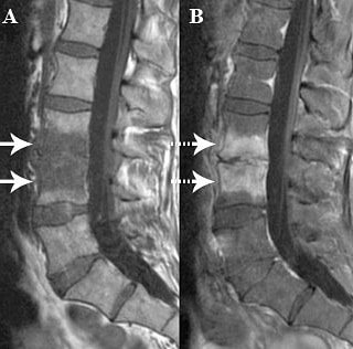 Suffolkspine's tweet photo. An MRI scan gives accurate information allowing treatment to be planned. #spine #sepsis #infection #discitis #mri #scan #mriscan #diagnosticimaging #diagnosis #sepsisawareness #thinksepsis https://t.co/Qp1m76VL2h