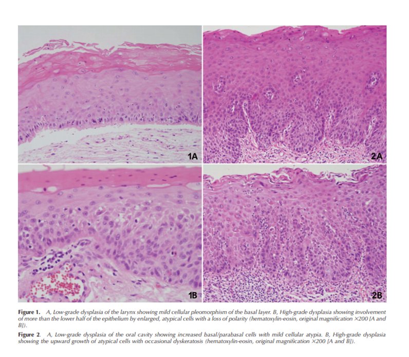 Recent changes to WHO classification of squamous intra-epithelial lesions of the head and neck discussed in this month's <a href="/ArchivesPath/">Arch Pathol Lab Med</a> buff.ly/2KKKkAR