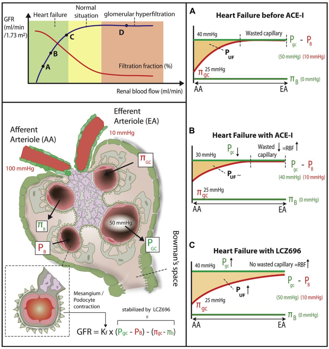 icorvilud's tweet photo. Paper on #HeartFailure & #glomerularfiltration: #Natriuretic #pathway might ameliorate renal #hemodynamics & #outcomes
https://t.co/6iTe7OzlSv
#FOAMed #ARNI #Sacubitril #Albuminuria #PARADIGM #cardiotwitter #cardioed #cardiorenal #heartyourkidneys #LCZ696 #HeartFailureMatters https://t.co/VlAqG0GHDe