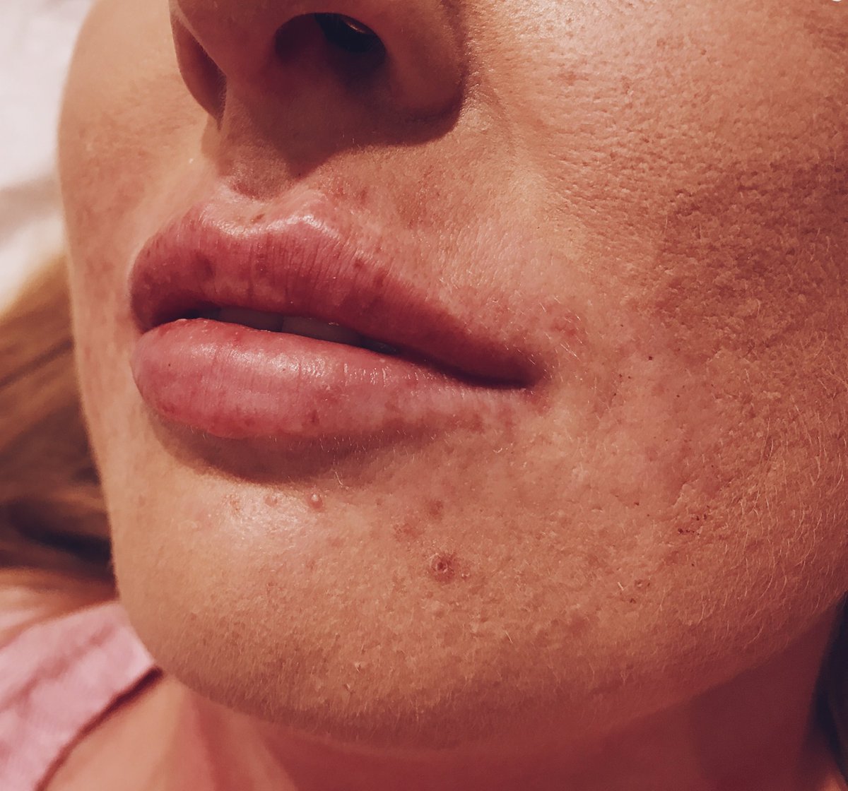 PodBeauty's tweet image. A L L   A B O U T   T H E   S M O O T H   💉

1 M L   L I P   F I L L E R   👈🏽👈🏽👈🏽

📞 01903 260985
📲 DM TO MAKE AN APPOINTMENT