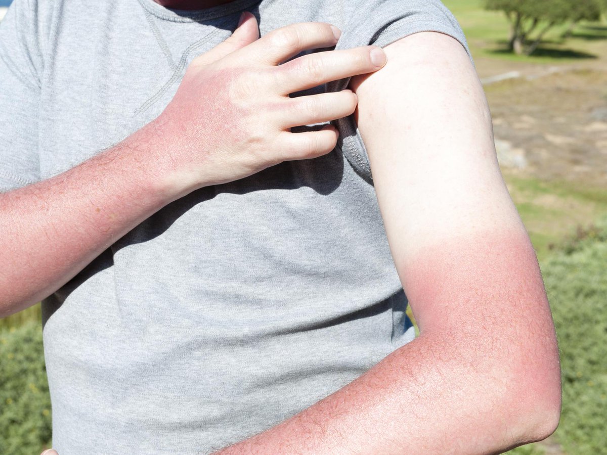 HerschthalDerma's tweet photo. Genes Controlling Whether Skin Tans or Burns Discovered by Scientists
(https://t.co/LDE4znuGp0)

#sunburn #skincancer #bocaraton https://t.co/7jhLvJ5yVd