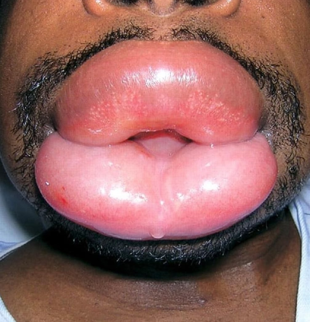 Drsazone On Twitter Adakala Selepas Makan Sesuatu Anda Mungkin Mengalami Gatal Gatal Kadangkala Lebih Teruk Sehingga Bibir Membengkak Jika Ini Berlaku Segera Ke Jabatan Kecemasan Hospital Dikhuatiri Saluran Pernafasan Juga Akan Membengkak