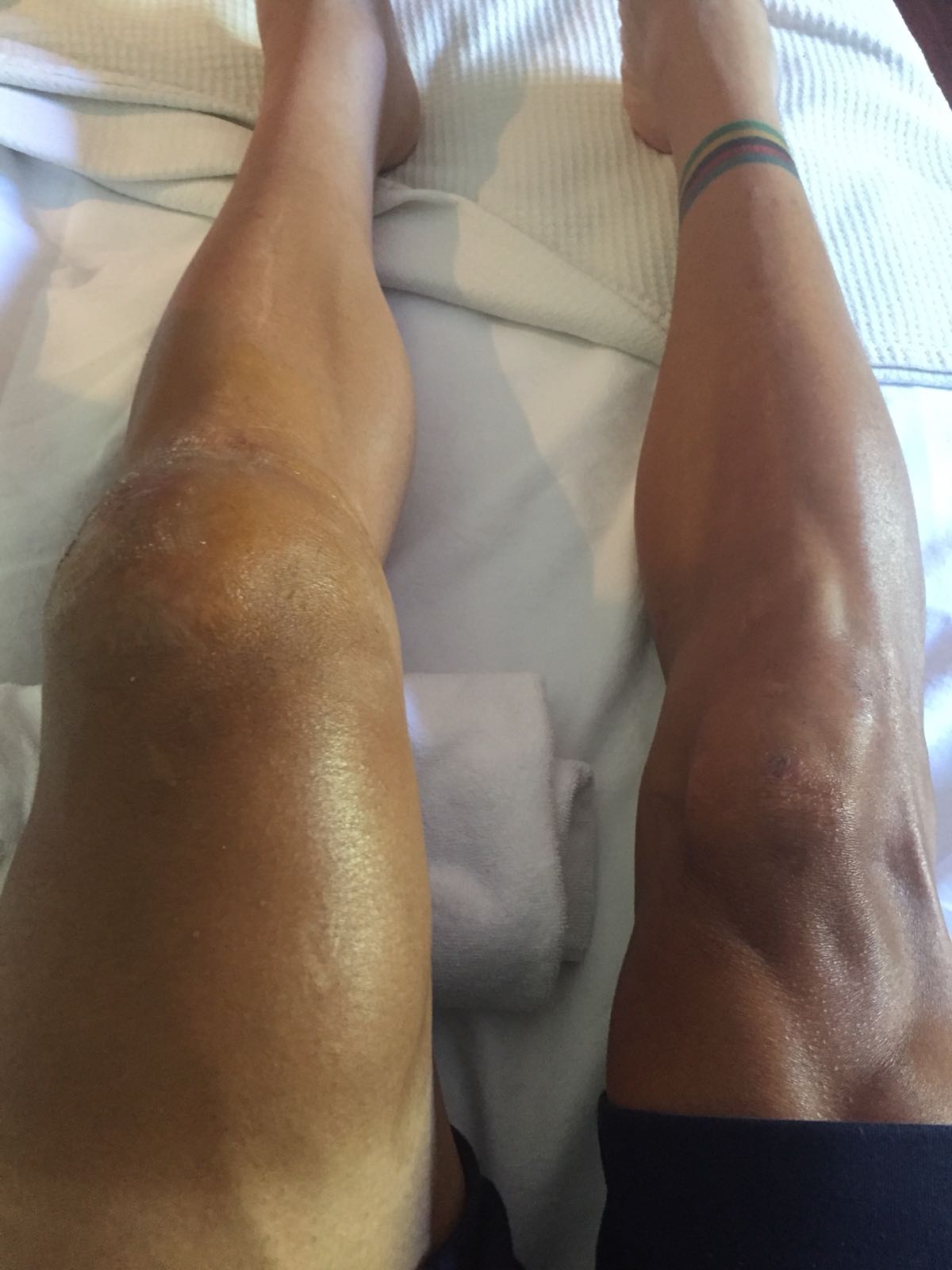 Cracked patella sale