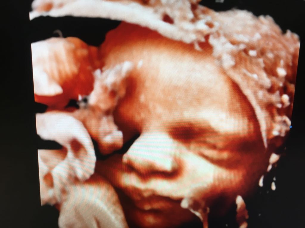 NeplodnostIVF's tweet photo. 40 godina IVF-a slavimo danas!!!
Omogućena je pomoć onima u kojih se neplodnost ne može drugačije izliječiti.
https://t.co/5TqfXnxZTx
#HappyBirthdayLouiseBrown #IVFbaby #IVF #Neplodnost #VelimirSimunic #PoliklinikaIVF #HumanaReprodukcija https://t.co/pwY4rLhlOL