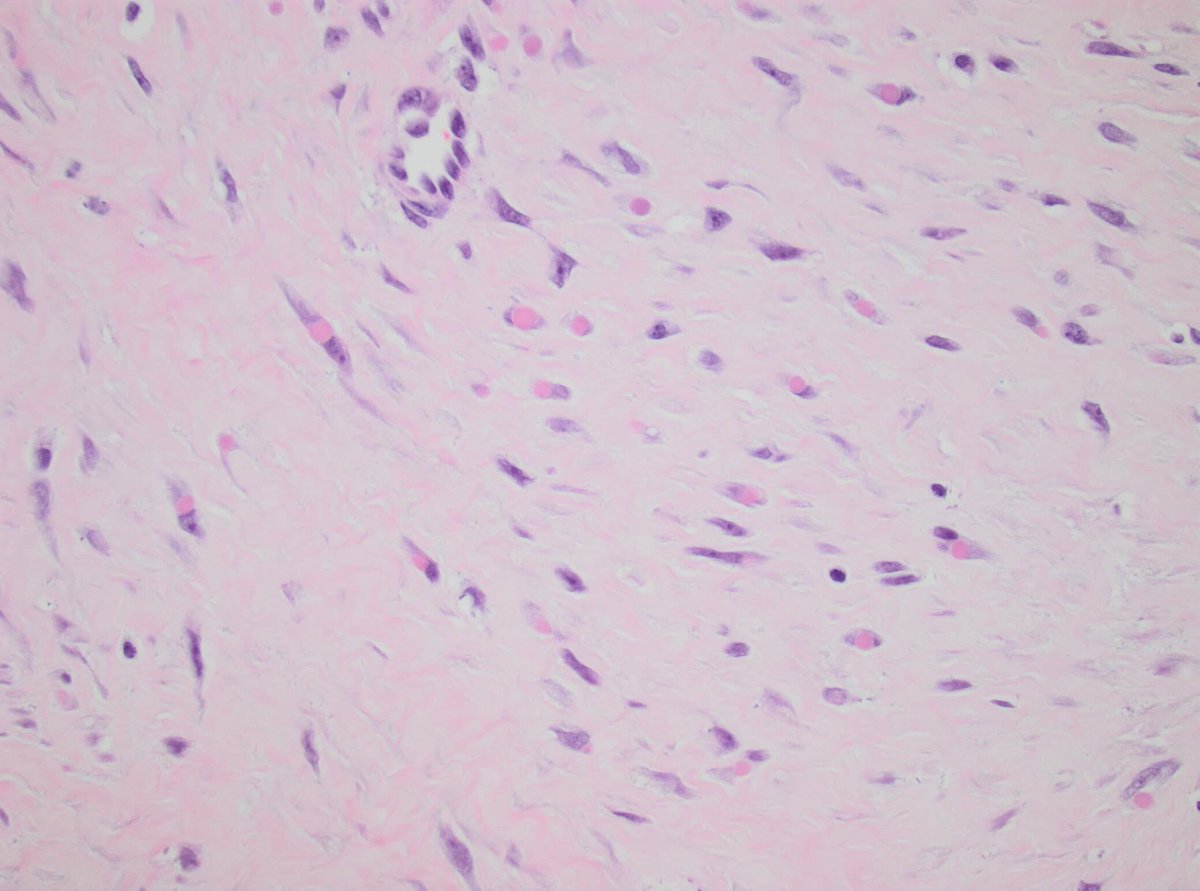 kirakira1712's tweet photo. A classical case of infantile digital fibromatosis, with Trichrome stain highlights the eosinophilic inclusions. So excited to see this rare entity the second time! #pedipath #pathology #boneandsofttissue #PathArt https://t.co/GZDKprmBsb