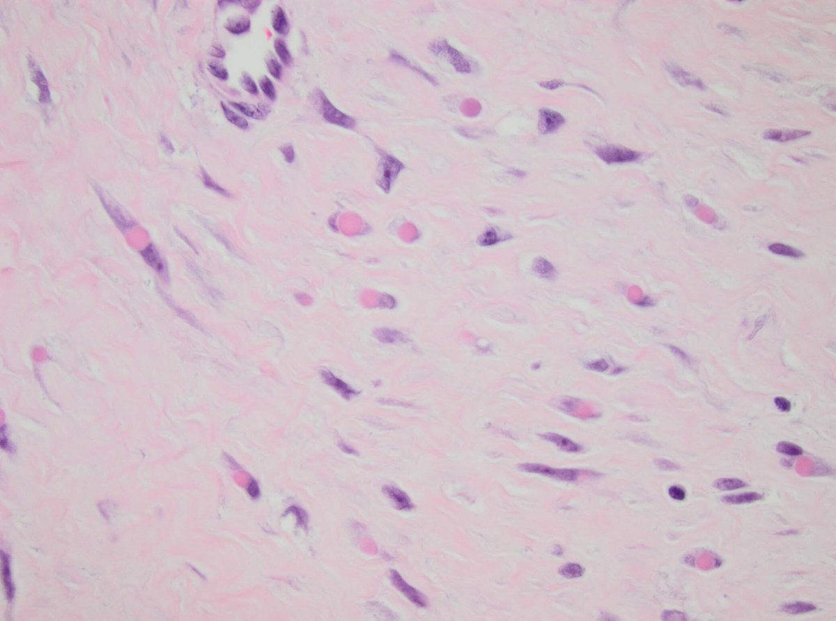 kirakira1712's tweet photo. A classical case of infantile digital fibromatosis, with Trichrome stain highlights the eosinophilic inclusions. So excited to see this rare entity the second time! #pedipath #pathology #boneandsofttissue #PathArt https://t.co/GZDKprmBsb