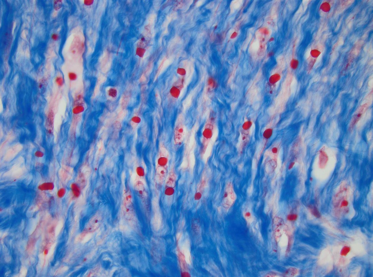 kirakira1712's tweet photo. A classical case of infantile digital fibromatosis, with Trichrome stain highlights the eosinophilic inclusions. So excited to see this rare entity the second time! #pedipath #pathology #boneandsofttissue #PathArt https://t.co/GZDKprmBsb