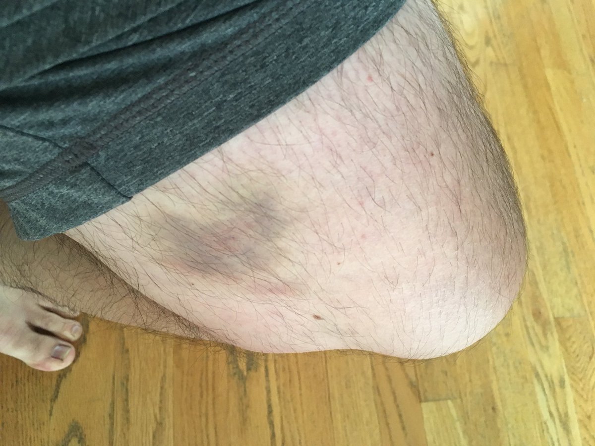 SCRHL's tweet photo. As all players of the best sport know, hockey bruises are an occupational hazard where the padding doesn’t cover (and, in some cases, where it does cover). What are some your worst war story bruises? #scrhl #adultrechockey #calgary #calgarylife #yycnow #calgarysports https://t.co/IHmSRoH30T