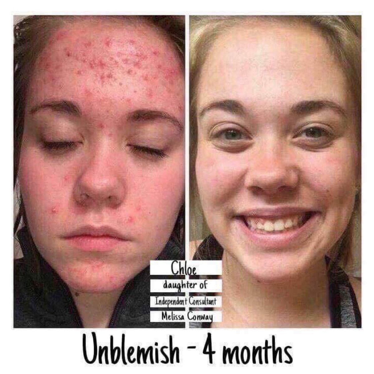 Joanie_Barr's tweet photo. Send your children back to school with clear skin and self confidence! 💜
Money 💰 back guaranteed #Unblemish #Goodbyeacne #Clearskin #Backtoschool. #acnescars #acne #skincareblogger https://t.co/VuEJWTyYi6