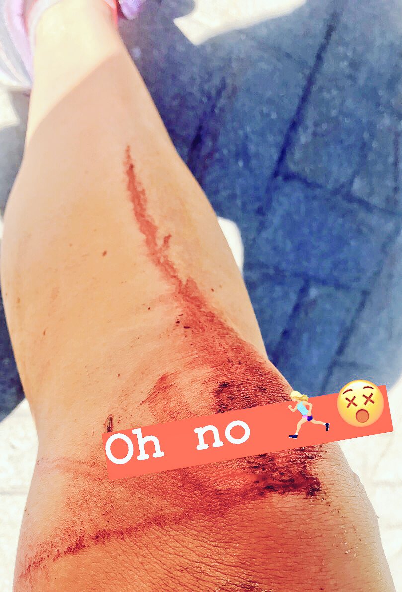 LoLoCoding's tweet image. Escaped to Whistler, CA last week to spend some time outside and unplug🔌. Ironically, I took a tumble while trail-running & now am stuck inside recovering. #backToCoding #OptOutside #ButThenGoBackInside #CantStopWontStopCoding 🤕👩🏼💻