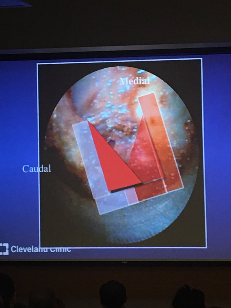 CleSpineReview's tweet photo. Steinmetz: 2 triangles of bone you remove (with drill and Rhoton instruments) for cervical microforaminotomy: IAP, then SAP. Palpate & stop at the pedicle #CLESpine https://t.co/McAV0ckHIK