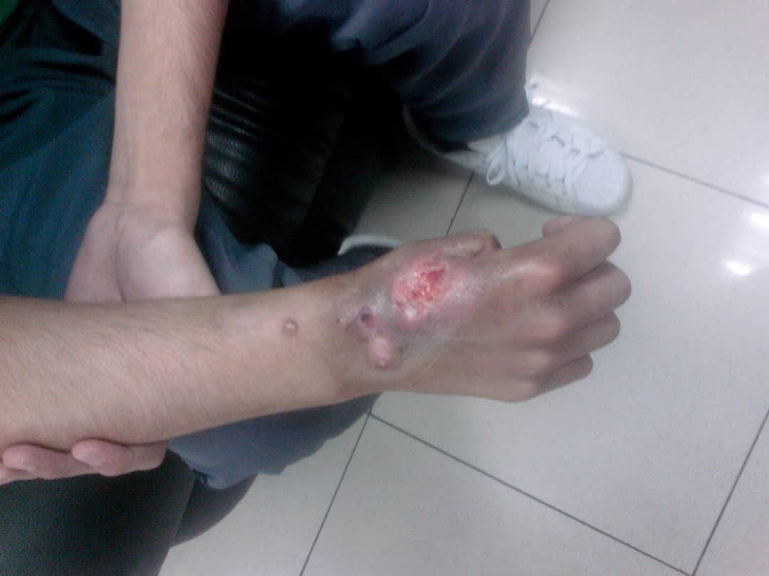 MamaLisVzla's tweet image. #ServicioPublico Ricardo Ravello, 19 años años, sufre cáncer óseo. Este año no ha podido recibir su quimio, y ya su brazo está a punto de ser amputado si no conseguimos las medicinas. NIVOLUMAB o IPILIMUMAB. Ruego a la persona o institución que pueda ayudar escribirme URGENTE!
