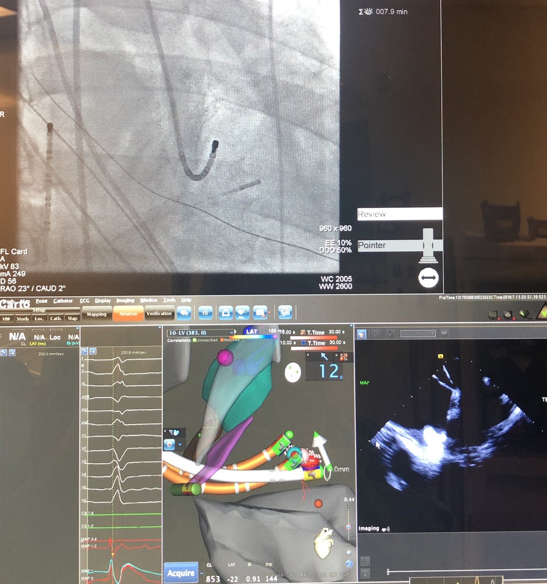 GDandamudiMD's tweet image. @DrRoderickTung @Hisdoc1 @rdschaller @narrowQRS @SergioPinski @drrakeshg1 @MoeenSaleem @True_EP @DoctorPhillEP @psharmadoc AMC PVC; Decanav &amp;amp; ICE-10 min mapping &amp;amp; then ablation #HDmapping #ICE