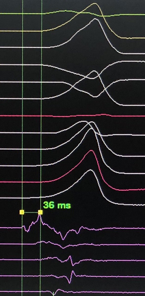 GDandamudiMD's tweet image. @DrRoderickTung @Hisdoc1 @rdschaller @narrowQRS @SergioPinski @drrakeshg1 @MoeenSaleem @True_EP @DoctorPhillEP @psharmadoc AMC PVC; Decanav &amp;amp; ICE-10 min mapping &amp;amp; then ablation #HDmapping #ICE