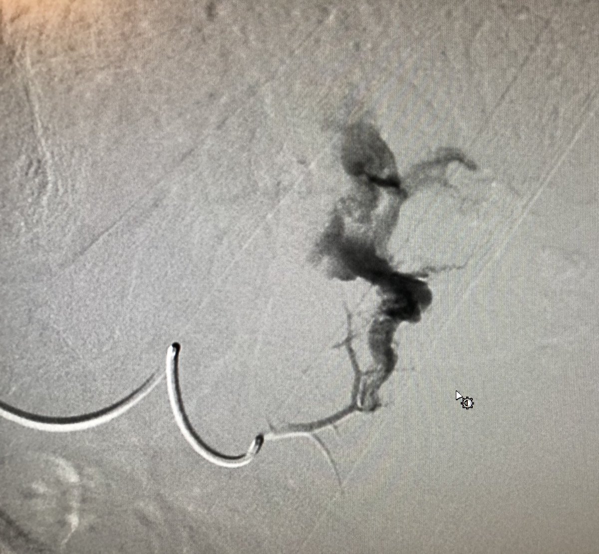 AndyBaadh's tweet photo. 23F s/p ATV accident noted to have splenic pseudoA with active extravasation and hemoperitoneum. Successful selective catheterization and coil embolization of the feeding vessels. No bleeding post w/ preservation of splenic parenchyma. #WithoutAScalpel #IRad https://t.co/p4U7Ct7Vkn