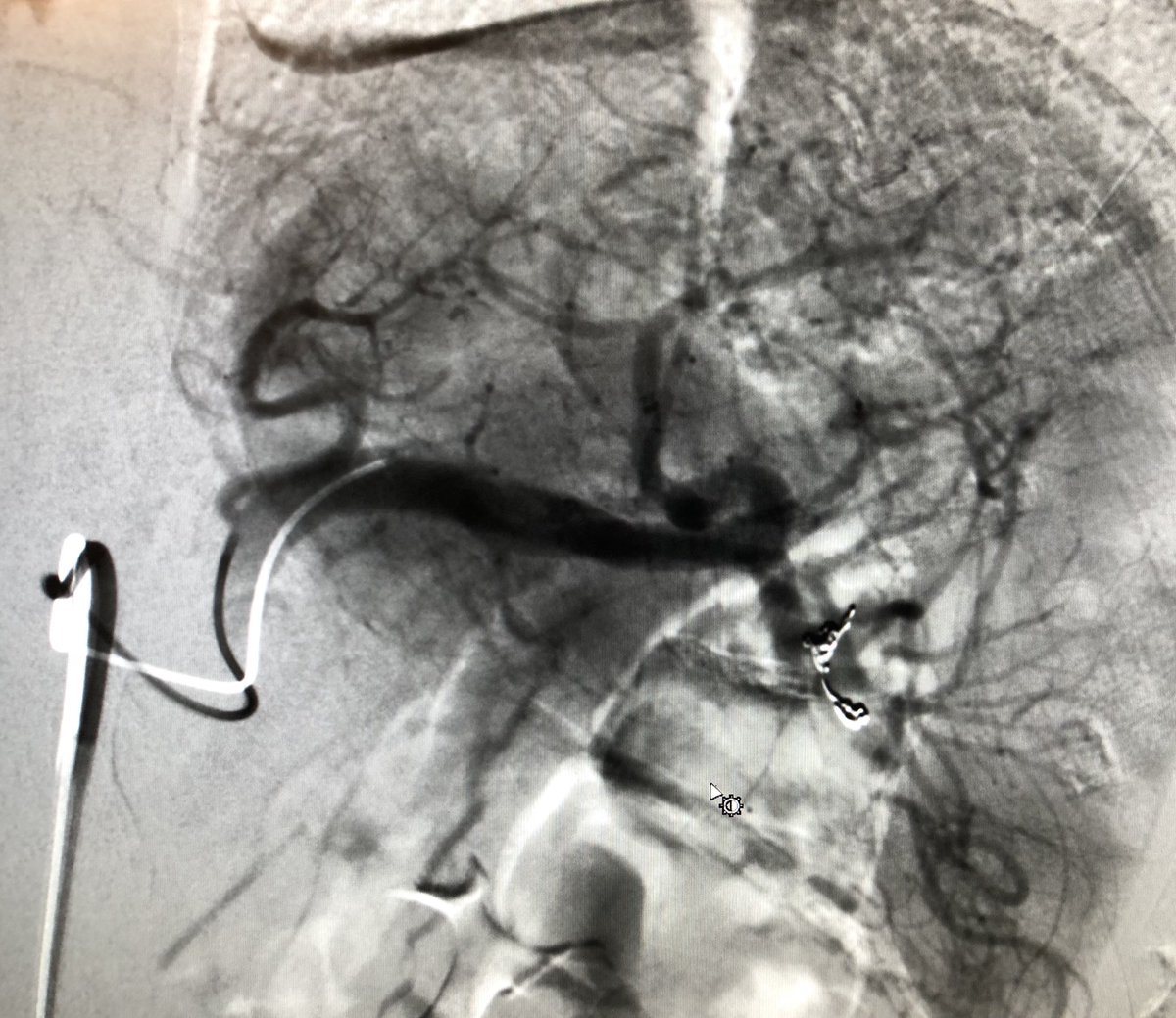 23F s/p ATV accident noted to have splenic pseudoA with active extravasation and hemoperitoneum. Successful selective catheterization and coil embolization of the feeding vessels. No bleeding post w/ preservation of splenic parenchyma. #WithoutAScalpel #IRad