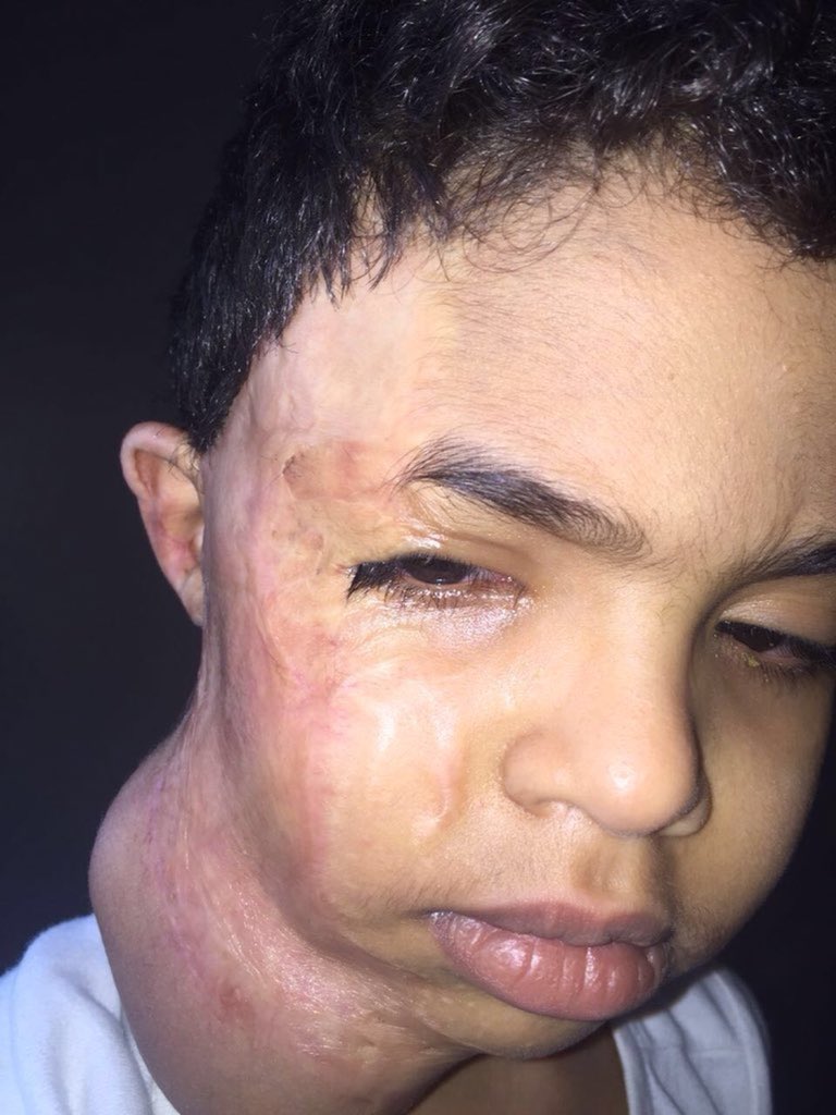 omar1scout's tweet image. #حالة_انسانية 🔴

تكفون يا جماعة الخير أم تناشد أهل الخير  إبنها عمليته بعد أسبوع في #فرنسا ولا تجد مبلغ العملية &quot; 50 الف ريال &quot; ، من يدلها على فاعل يتكفل بالعملية يتواصل على الرقم التالي  | 0502939495

انشر لعلك تؤجر بارك الله فيك ⚘