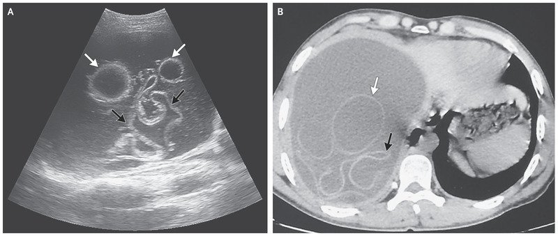 CaroUrbinaCUCS's tweet photo. Quistes hidatídicos hepáticos (causados por E. granulosus) en un paciente de 30 años de edad habitante de Marruecos, identificados en USG (imagen A) y tomografía computarizada  (imagen B). En N Engl J Med 2018; 379:181 @NEJM 
@gabcn0414 #lakkesvida #udgagora https://t.co/v7xwLrfgGL