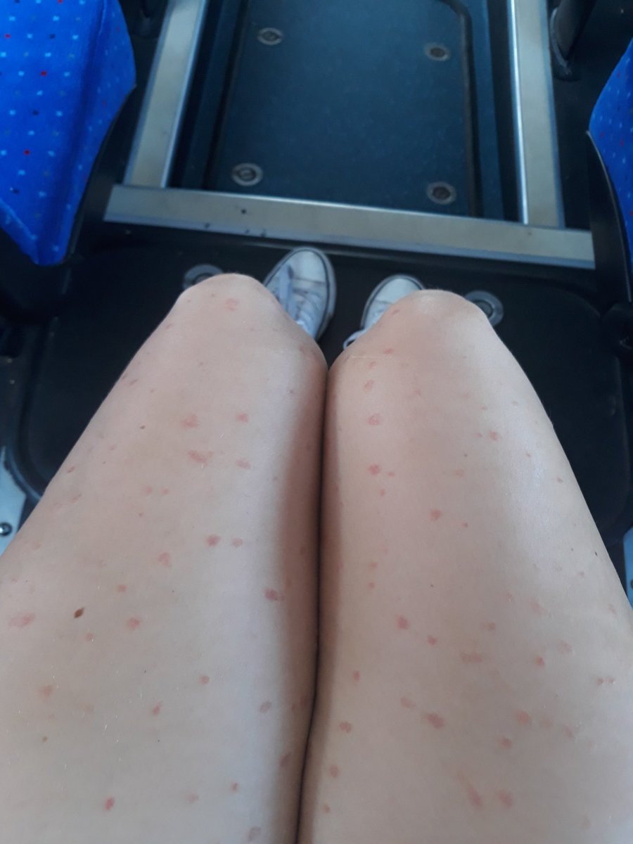 Linzi_bbz's tweet photo. Really I want to hide my gross #psoriasis legs but the sun will do them good. So I'm ready for all the stares π #canthelpit #imnotcontagious https://t.co/ZQ16x7EOXi