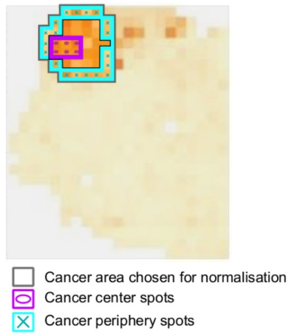 eriksonnhammer's tweet photo. Spatial pathway analysis of cancer center vs periphery in a developing prostate tumor. 
Nature Comm. 9:2419. https://t.co/rkkD60JWnb https://t.co/MLxRxLgtR2