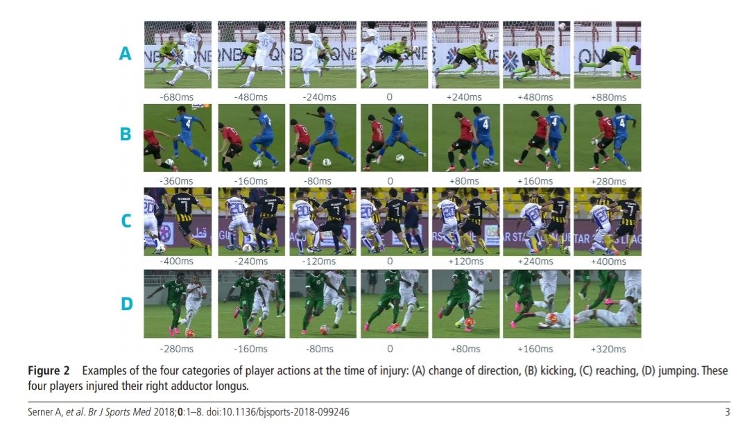 Check out our new study with video analysis of adductor longus injuries!
bit.ly/2JmG7On