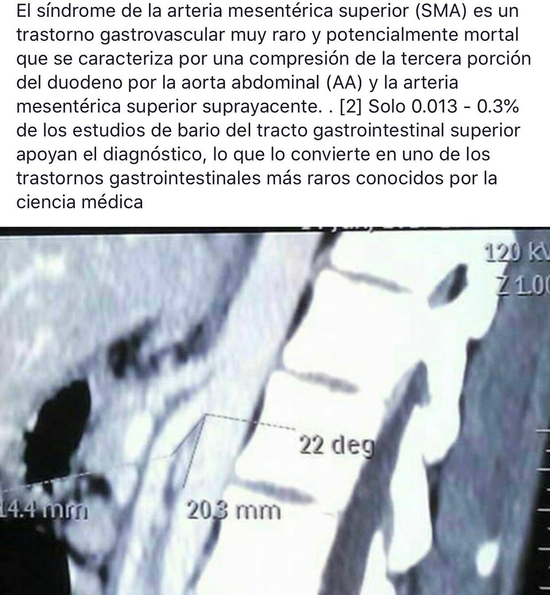 Yo conviví y sobreviví al #SíndromeDeWilkie, much@s de los afectados, hoy, no tienen voz.

La enfermedad decidió apagársela. No dejemos que esto siga ocurriendo.

#EnfermedadesRaras #Investigación #SindromePinzaAortoMesentericaSuperior