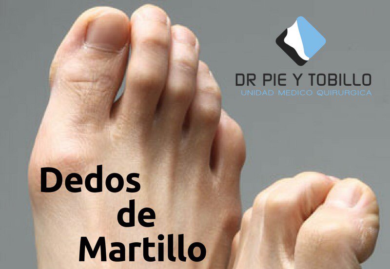 ¿Dedo de martillo? || El dedo en martillo es una deformidad de los dedos pequeños del pie. Es llamada así por la forma que adquieren los dedos que simula un martillo.

 #drpieytobillo #pies #tobillo #traumatologia #venezuela #españa #bilbao