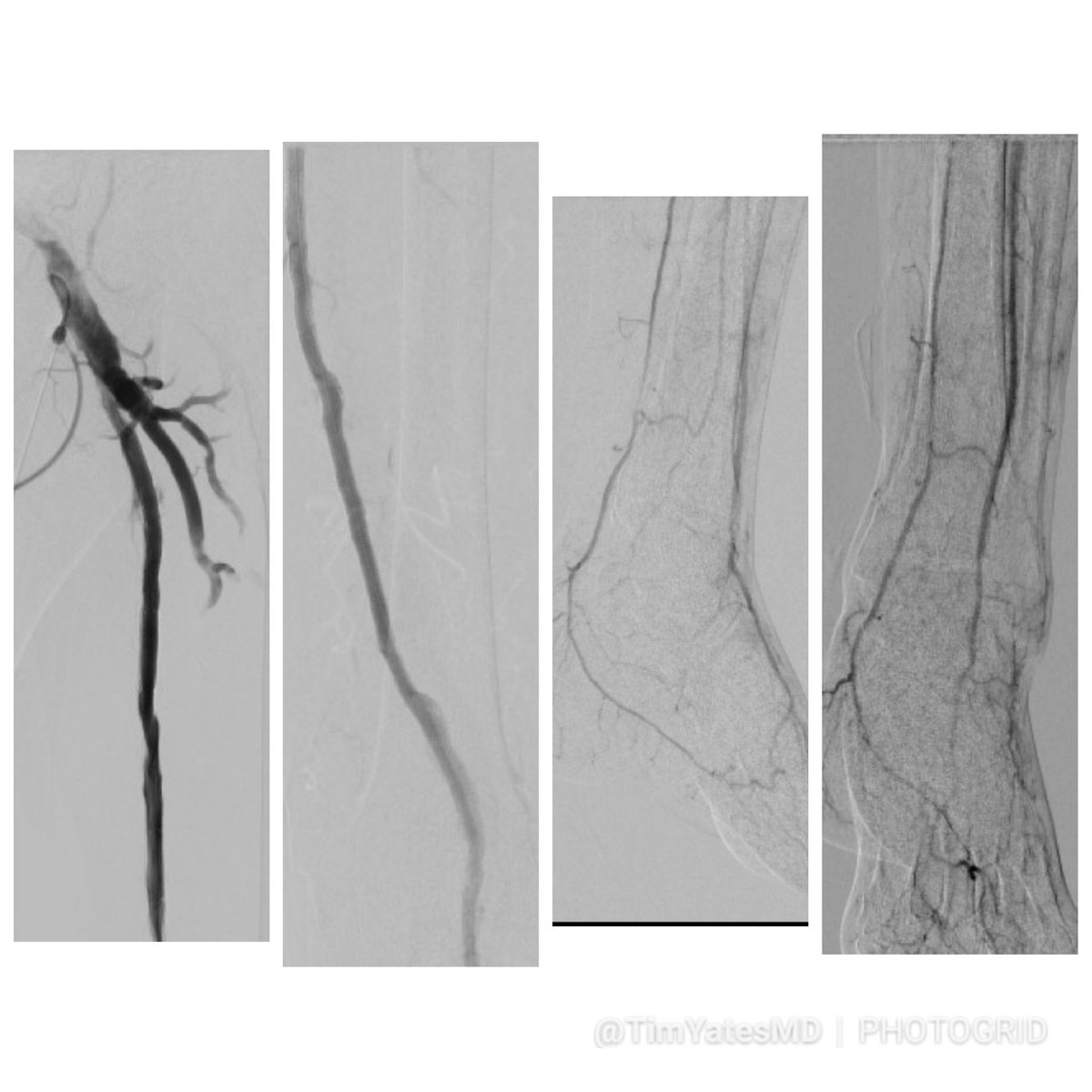 SOBE_Vascular's tweet photo. 85 yo M RC6 #CLI, L 5th MTP osteo, nonsurg. Ante-retro (CFA-PT) recan, @AbbottGlobal  #supera @belzerj @CookMedical #zilverptx . No flow >3v #inlineflow . #mylegmylife #CLIFighters @AMPSymposium @NCVHonline @JVIRmedia @SIRRFS @kmadass @docTPlive @Mustapja @FadiSaab17 @drsavealimb https://t.co/dje9LDounq