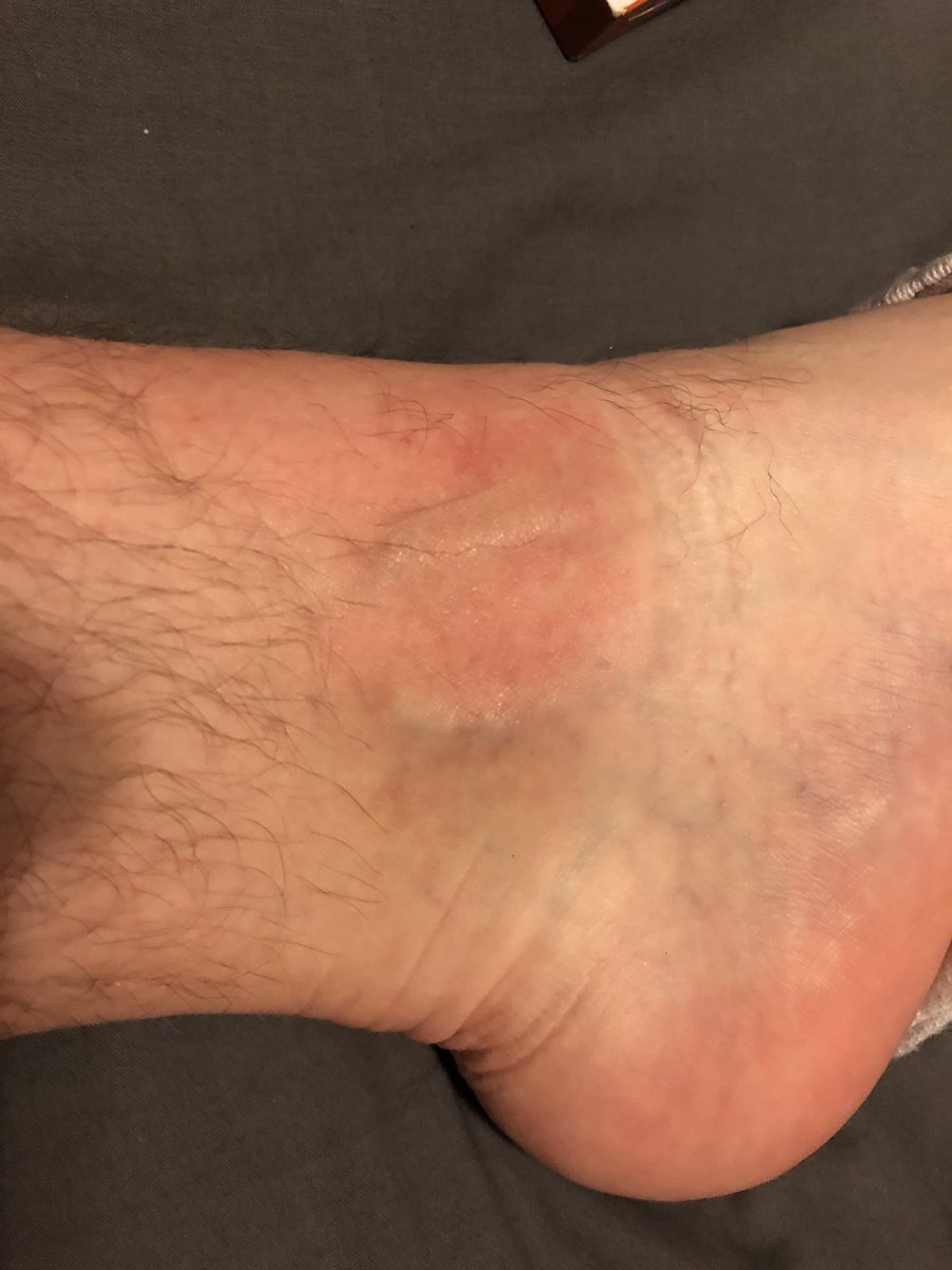 GrungeNorris's tweet photo. Nearly broke my ankle in a #pothole in #Shoreditch yesterday on my way back from my performance at the #antidotefestival at #TheMacbeth of #Hoxton walking along minding my own business 1 minute then the next arse over tit did ur humble narrator fly โน๏ธ Watch the #roadworks ๐ค https://t.co/p2jibHpk2x