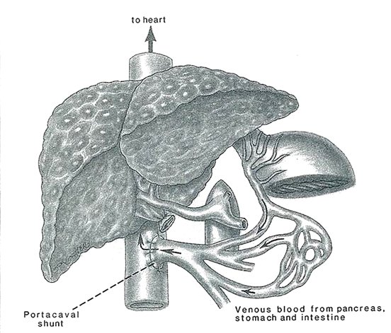 So, McDermott cared for a man with painless jaundice.In the OR: A 5cm pancreatic cancer with superior mesenteric vein involvement. To resect in 1 stage, he smacked the portal vein onto the inferior vena cava- Eck fistula!He pub'd this story in 1952: https://www.ncbi.nlm.nih.gov/pmc/articles/PMC1802351/?page=4