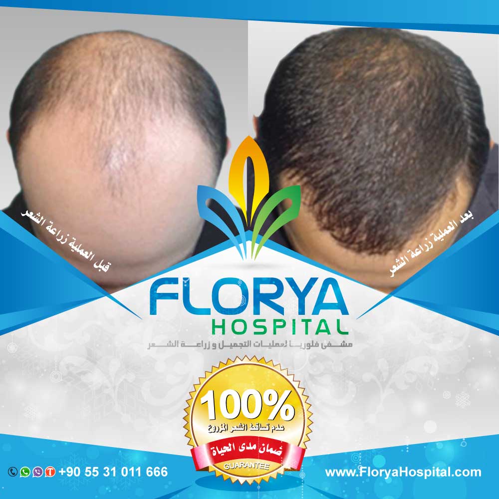 FloryaHair's tweet photo. أفضل اطباء تركيا في زراعة الشعر
كاس عالم / #النهايي_الكبير_فرنسا_كرواتيا
زراعة الشعر بتقنية DHI , FUE
أفضل التقنيات المستخدمة بخدمات VIP
ويل سميث / #نهايي_كاس_العالم2018
احجز الأن :
☎️ 00905531011666
https://t.co/CwqS5F9SZM https://t.co/IU0OSvmmNM