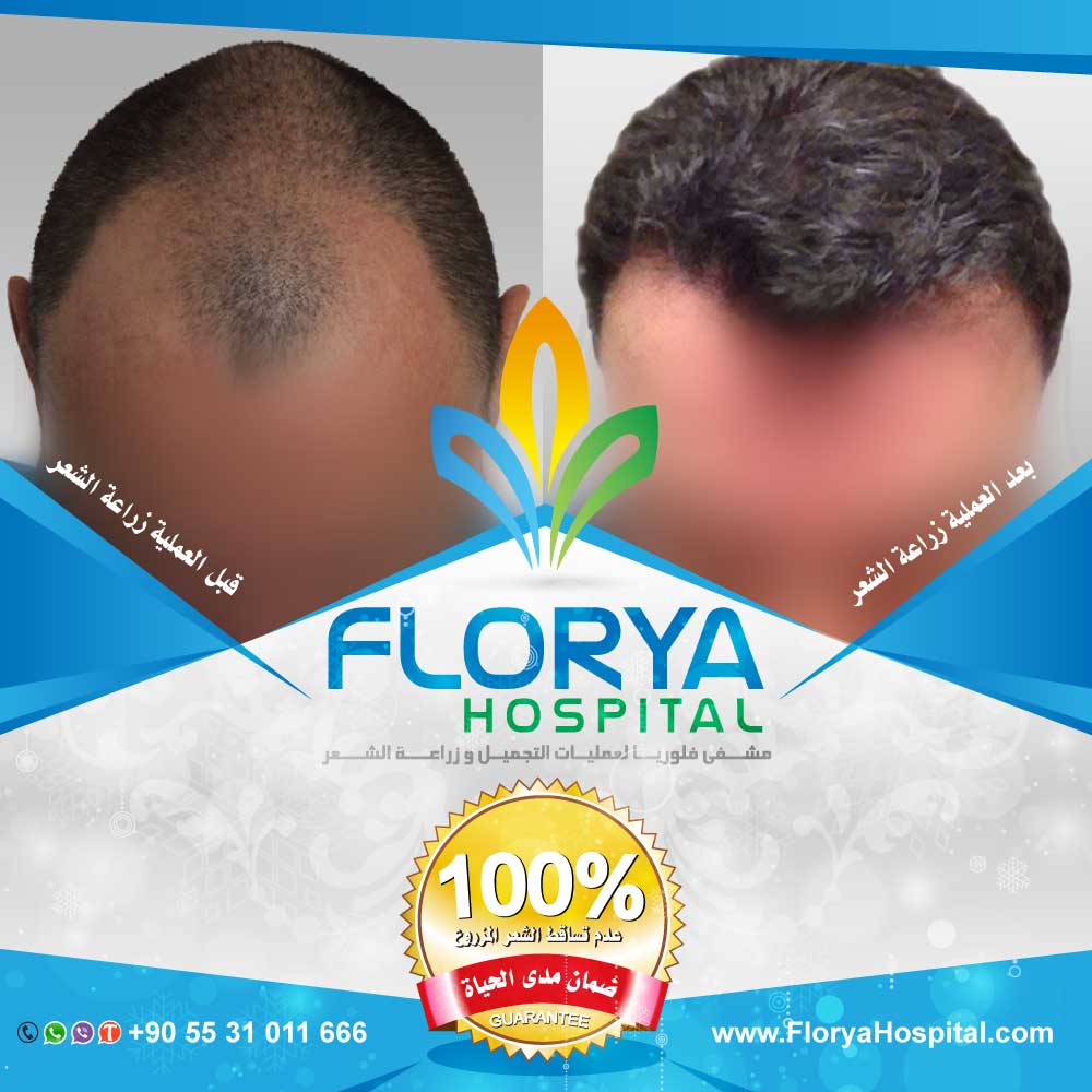 FloryaHair's tweet photo. أفضل اطباء تركيا في زراعة الشعر
كاس عالم / #النهايي_الكبير_فرنسا_كرواتيا
زراعة الشعر بتقنية DHI , FUE
أفضل التقنيات المستخدمة بخدمات VIP
ويل سميث / #نهايي_كاس_العالم2018
احجز الأن :
☎️ 00905531011666
https://t.co/CwqS5F9SZM https://t.co/IU0OSvmmNM