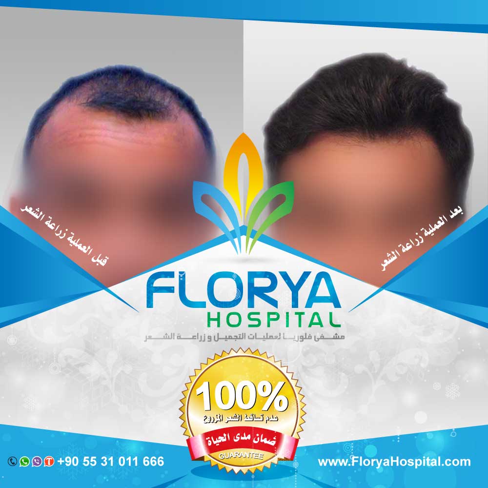 أفضل اطباء تركيا في زراعة الشعر
كاس عالم / #النهايي_الكبير_فرنسا_كرواتيا
زراعة الشعر بتقنية DHI , FUE
أفضل التقنيات المستخدمة بخدمات VIP
ويل سميث / #نهايي_كاس_العالم2018
احجز الأن :
☎️ 00905531011666
FloryaHospital.com