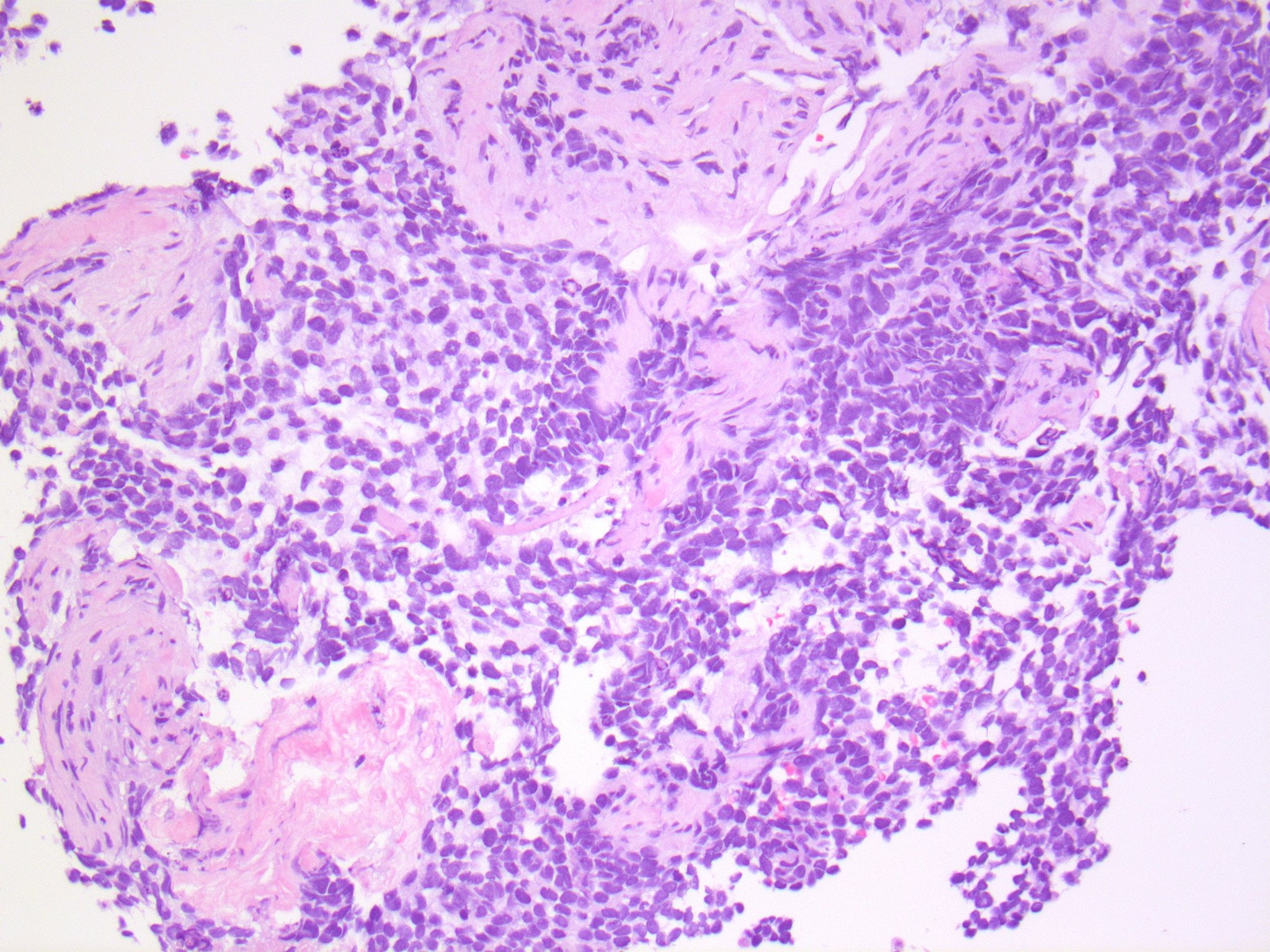 Brendan Dickson, MD on Twitter &quot;ALVEOLAR IHC