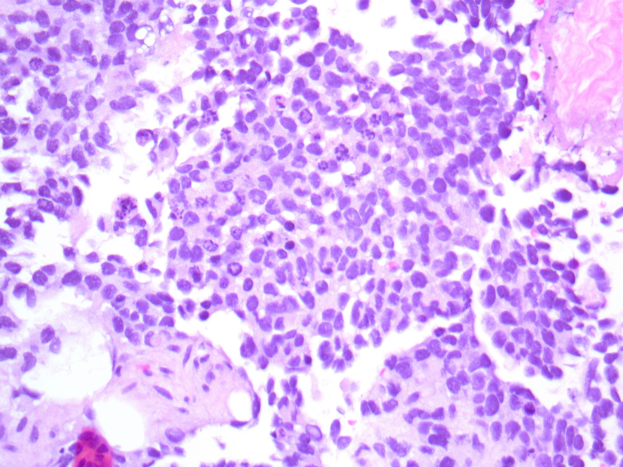 Brendan Dickson, MD on Twitter &quot;ALVEOLAR IHC