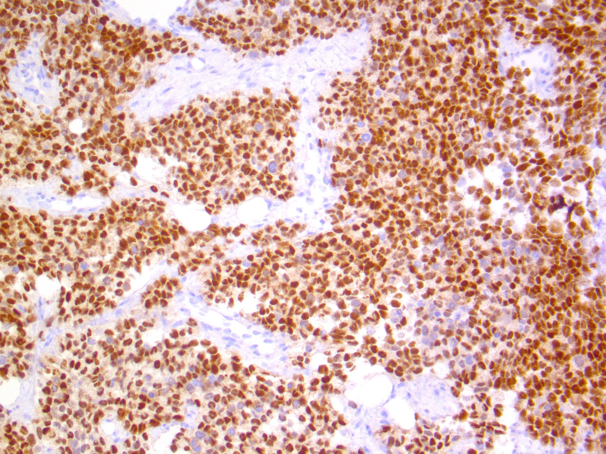 Brendan Dickson, MD on Twitter &quot;ALVEOLAR IHC