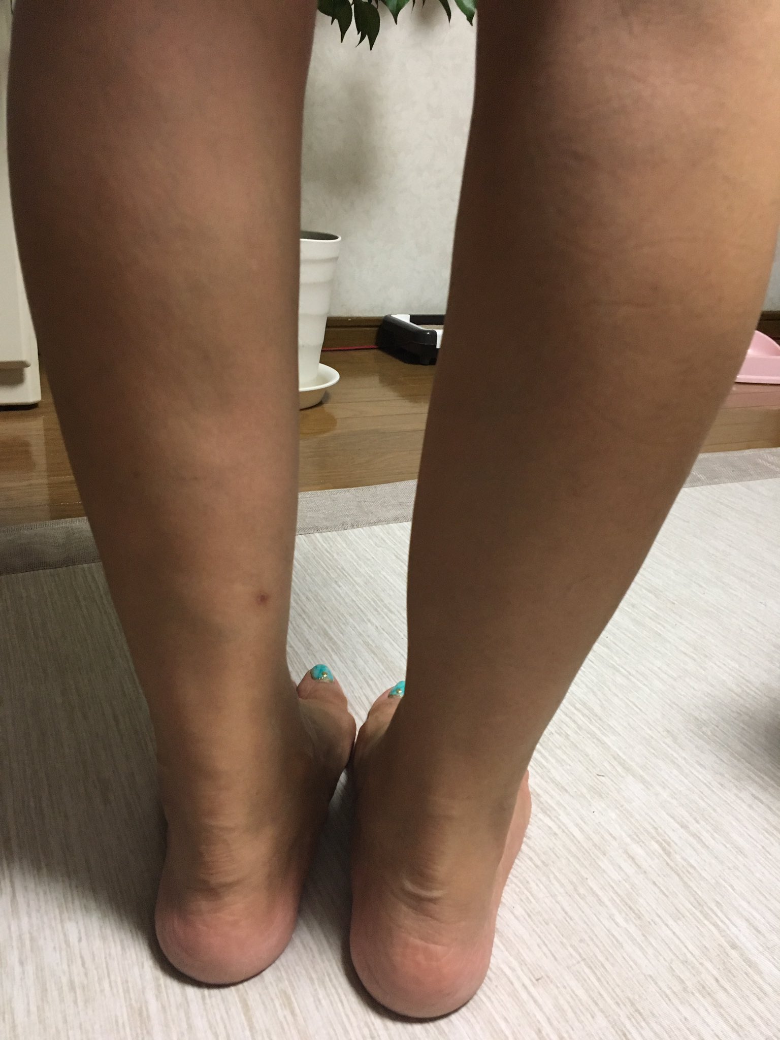 たかこ アキレス腱断裂 手術しないで保存療法を選択し一年 手術痕がないのでこの時期足を出すのに躊躇しなくていいのは嬉しい ただ 切れたアキレス腱は太いまま これは仕方ないらしい お見苦しい足ですが 記録用に載せます 左 やっぱり細いな
