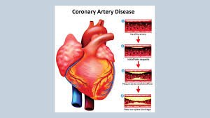 Neuroendocrino1's tweet photo. #Coronary #Artery #Diseases in South Asian Immigrants: Philosophy behind #HDL #Function
Know more: https://t.co/lhmkW0XOQU https://t.co/pmcH7L1tAJ