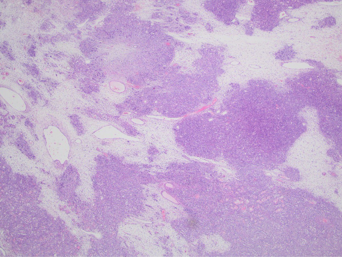 APsantpau's tweet image. New #DailyDx. 40yo woman with an ovaric mass (18 cm). Very impressive case...what’s your #diagnosis ?              #gynpath #Gynecology #GIPAth #pathology #diagnosticar