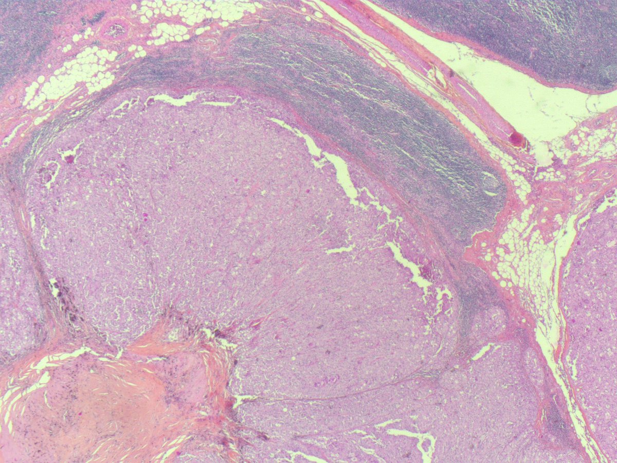 Tenonhospital's tweet photo. #Metastases of a MASC mammaglobin, CK7, PS100+ #ENTPath @ENTpathology https://t.co/m1dURgkZK0