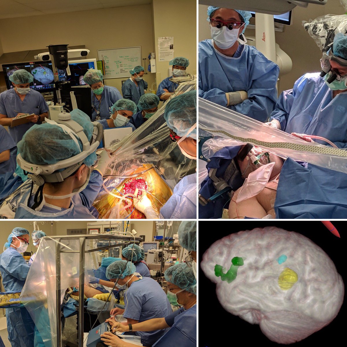 DrWalterJean's tweet photo. #awakecraniotomy for #corticalmapping and tumor resection. Everyone has to bring their A game: anesthesiologist, electrophysiologist, neuropsychologist, #neurosurgeon and most importantly, the patient! https://t.co/QuSByru4XZ