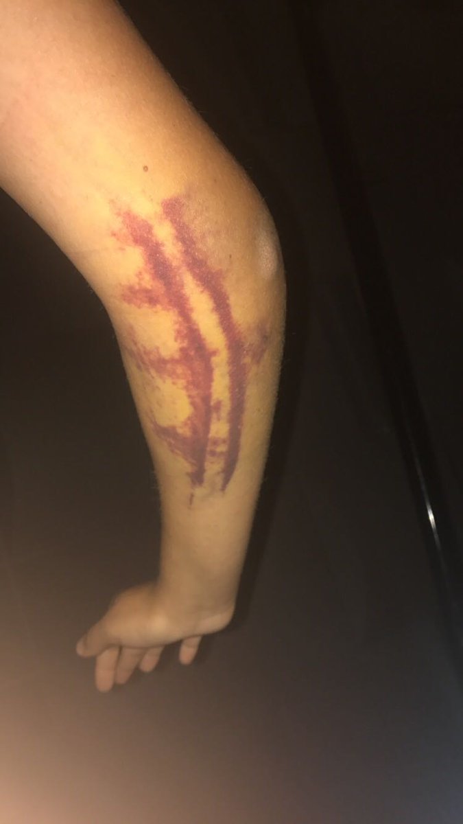 Rt or you finna break your elbow like I did 😭😂