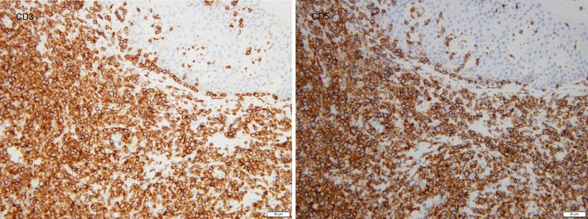 Dermpathl's tweet photo. This mycosis fungoides shows a double negative (CD4-, CD8-) phenotype.  M, 70s. Cells were negative for CD56 and granzyme B (not shown).  #dermpath #hemepath https://t.co/6NjM7AV7rg