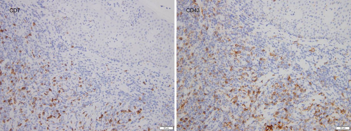 Dermpathl's tweet photo. This mycosis fungoides shows a double negative (CD4-, CD8-) phenotype.  M, 70s. Cells were negative for CD56 and granzyme B (not shown).  #dermpath #hemepath https://t.co/6NjM7AV7rg