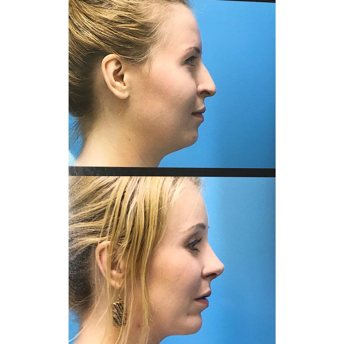 DrHaroldBafitis's tweet photo. Looking for life changing results that can change your whole look, search no further and come to Dr. Bafitis for your Rhinoplasty!
•Double Board Certified Plastic surgery, General surgery
•25 years experience 
•Just spoke at 35th Anniversary of Alexandria Egypt Facial plast SX https://t.co/pkBgi7yWtY