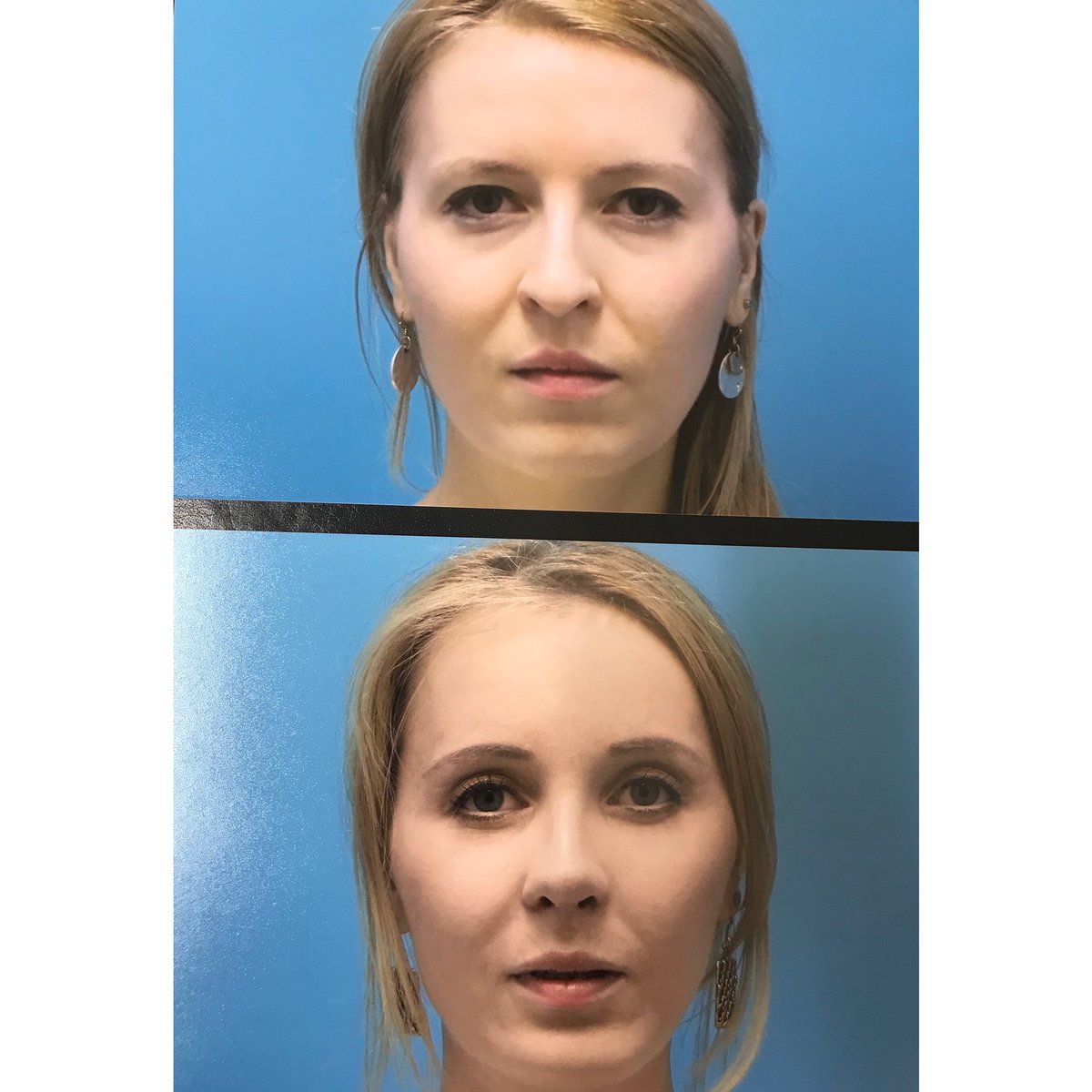 DrHaroldBafitis's tweet photo. Looking for life changing results that can change your whole look, search no further and come to Dr. Bafitis for your Rhinoplasty!
•Double Board Certified Plastic surgery, General surgery
•25 years experience 
•Just spoke at 35th Anniversary of Alexandria Egypt Facial plast SX https://t.co/pkBgi7yWtY