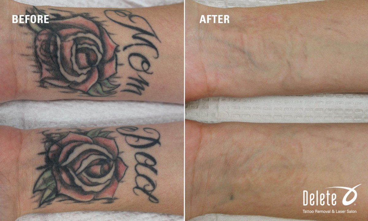 PicoWay Laser Tattoo Removal in Toronto  SpaMedica