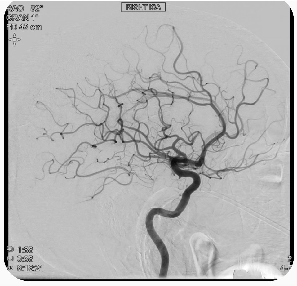 SIRRFS's tweet photo. #MedStudents &amp; #IRadRes: please join us in discussion for week 3 of the Neurointerventional Radiology Student/Resident Clinic Forum! Those who post will be entered into a raffle to win a $50 amazon gift card! #IRad #MedEd https://t.co/251kk4N84h Here are some images from the case https://t.co/Zt0Ucars9M