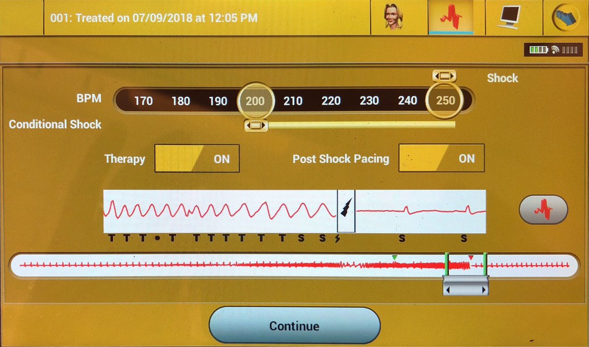 Andrew Voigt (@andrewvoigtmd) on Twitter photo Pt with SICD shock during TENS for low back pain. Her chiropractor proceeded even though she told him she has an ICD. I am seeing this a few times per year. Frustrating. More education required. <a href="/narrowQRS/">JMC</a> <a href="/DrJCheungEP/">Jim Cheung</a> <a href="/melchami99/">Mikhael El-Chami</a> <a href="/KrishKancharla/">Krishna Kancharla</a> <a href="/PittCardiology/">Pitt Cardiology</a> #EPeeps Pt with SICD shock during TENS for low back pain. Her chiropractor proceeded even though she told him she has an ICD. I am seeing this a few times per year. Frustrating. More education required. <a href="/narrowQRS/">JMC</a> <a href="/DrJCheungEP/">Jim Cheung</a> <a href="/melchami99/">Mikhael El-Chami</a> <a href="/KrishKancharla/">Krishna Kancharla</a> <a href="/PittCardiology/">Pitt Cardiology</a> #EPeeps