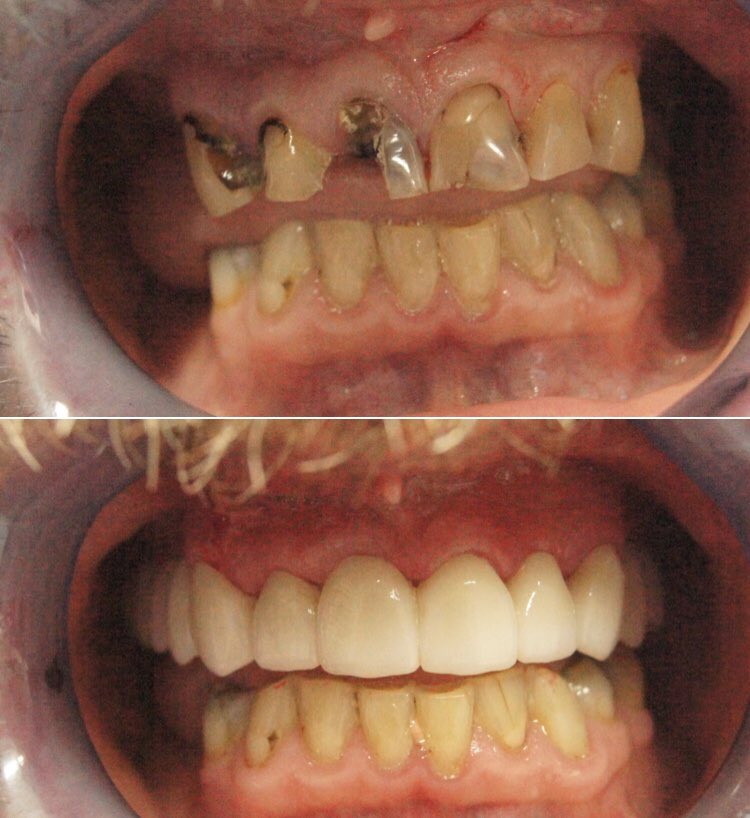 Amazing before and after pictures of one of our patients

Now they have the smile they’ve always wanted

Book your appointment now on 01512860330

#crosbydental #dentistliverpool #cosmeticdentistry #perfectsmile